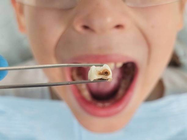 Best Emergency Broken Tooth Repair in Shavano Park, TX